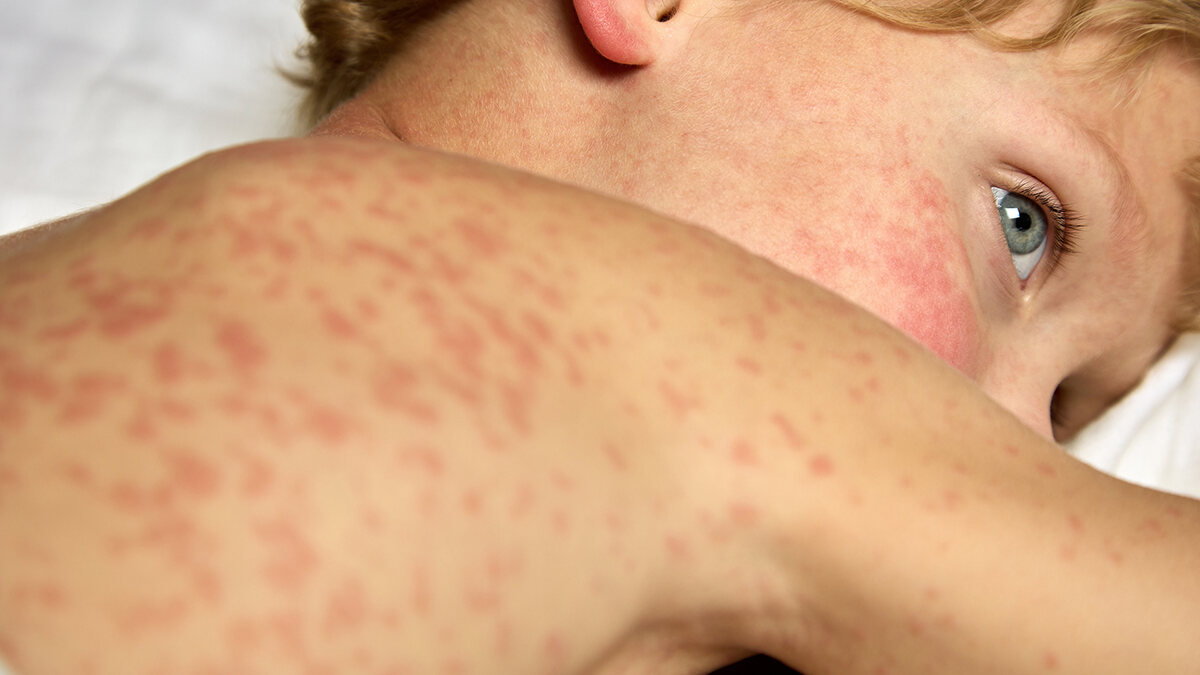 শিশুর হাম (Measles) : অভিভাবকদের জন্য গুরুত্বপূর্ণ ১০টি তথ্য